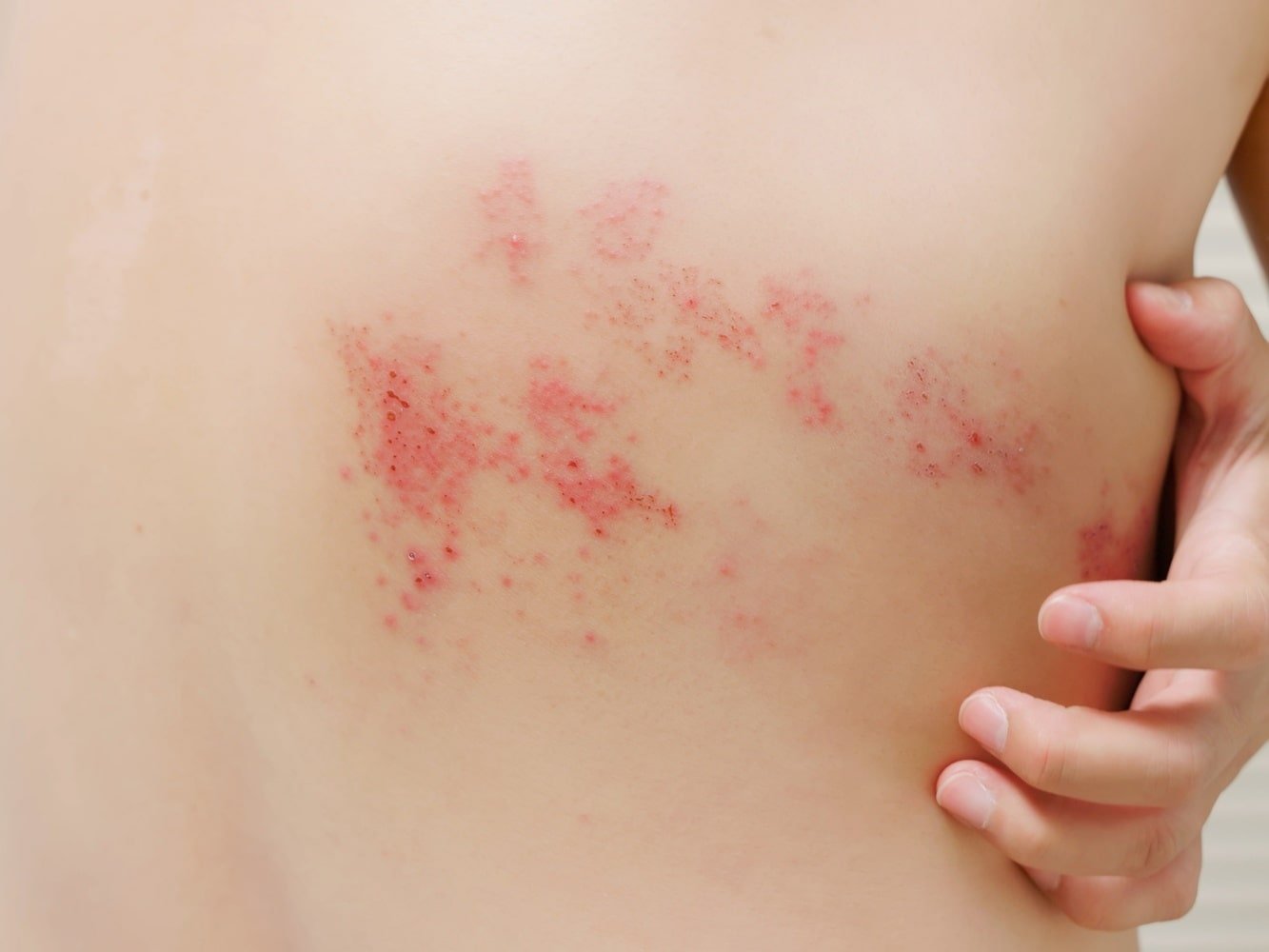 enfermedad de la piel zona debida al estrés