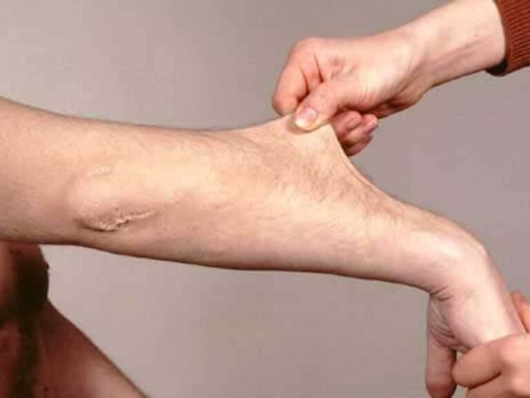 Ehlers-Danlos syndroom