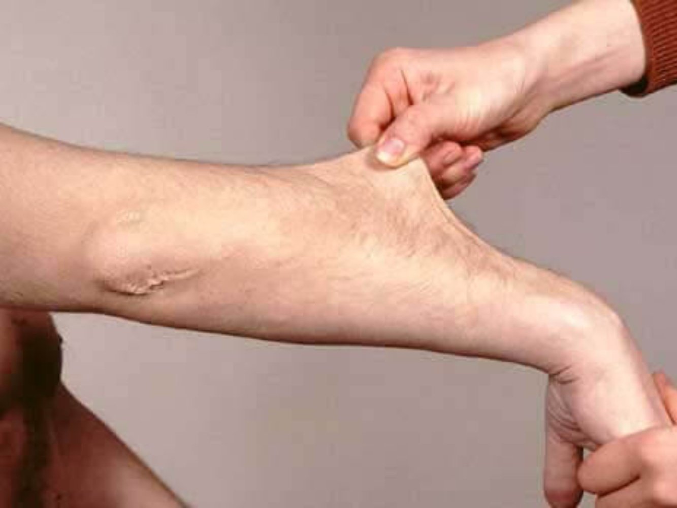 Ehlers-Danlos syndrome